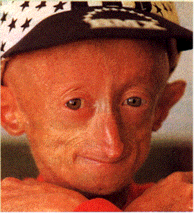 child with Progeria